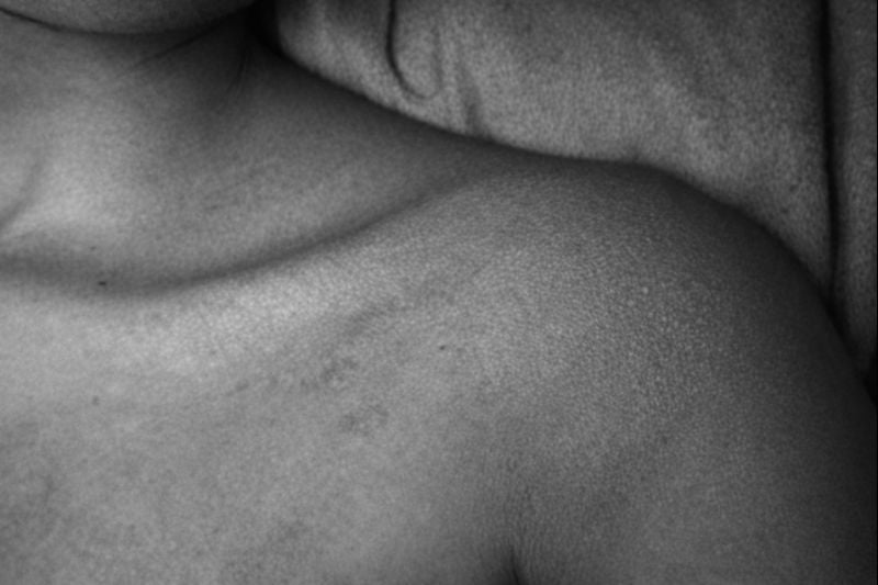 Living with Eczema