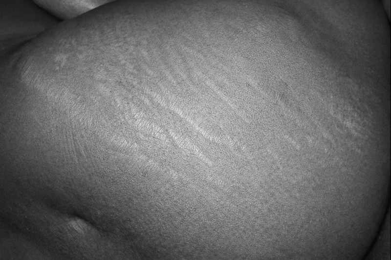 Stretch Marks and Skin Changes
