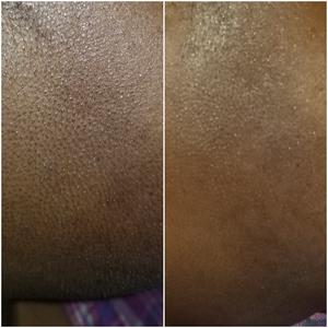 How I Conquered Keratosis Pilaris